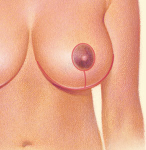 breast lift incision