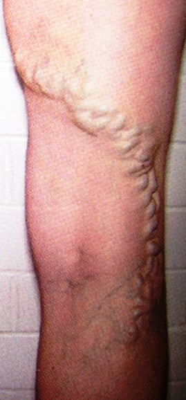 varicose veins
