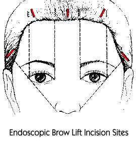 EndoscopicBrowLiftIncisionS