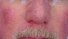 rosacea