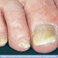 nail fungus
