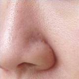 enlarged pores