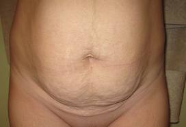 stretch marks