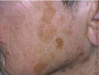 age spots