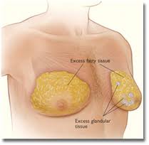 gynecomastia