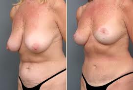 breast lift