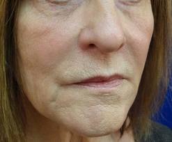 lip lines