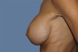 implant rippling
