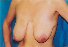 sagging breasts