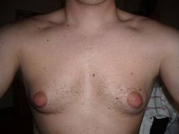 gynecomastia