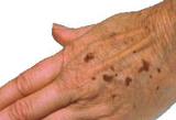 age spots