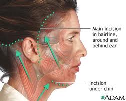 facelift incisions