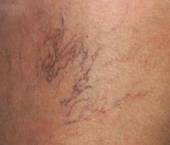 spider veins