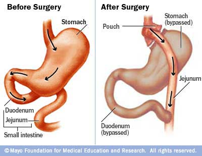 gastricbypass
