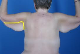 arm reduction