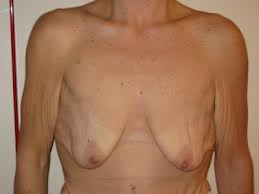 sagging breasts after weight loss