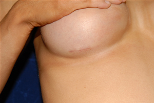 inframammary incision
