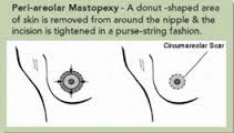circumareolar incision