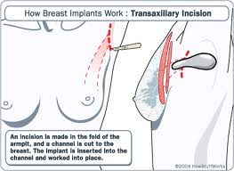 transaxillary breast augmentation