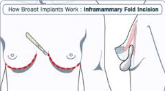 inframammary incision