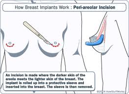 peri-areolar incision