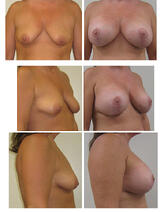 lift with augmentation