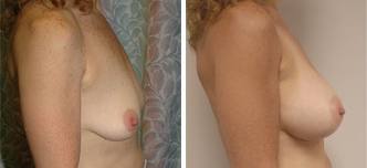 breast pseudoptosis