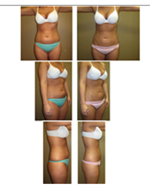 liposuction of abdomen and hips