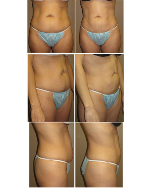 liposuction abdomen and hips