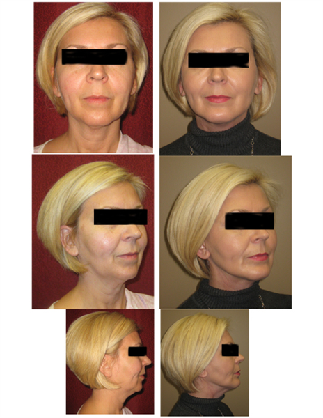 mini lower face and neck lift with chin implant