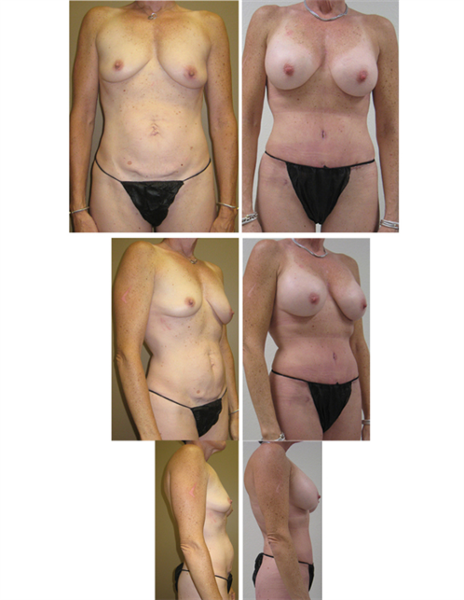 mini tummy tuck with breast augmentation