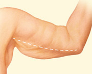 arm reduction incision